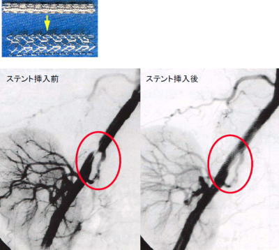 「プレス試料中の図2: ステントの使用例」の画像