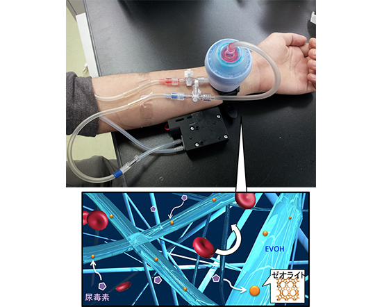 「プレス資料中の図1　電気や水などのライフラインが寸断された緊急時でも利用可能な腕時計型の尿毒素除去システム (イメージ図) 。腕時計にはゼオライトを含有したエチレンビニルアルコール(EVOH)からなるナノファイバーが装着されており、尿毒素を吸着する仕組みになっている。」の画像